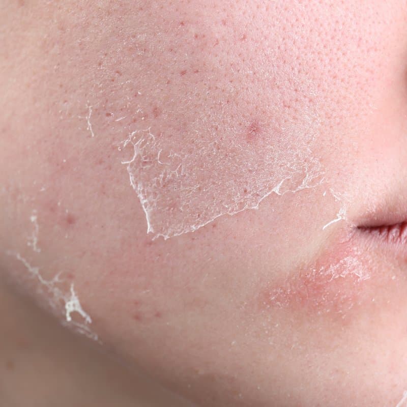 Le Calcaire : L'Ennemi Invisible de Votre Peau et Cheveux sous la Douche